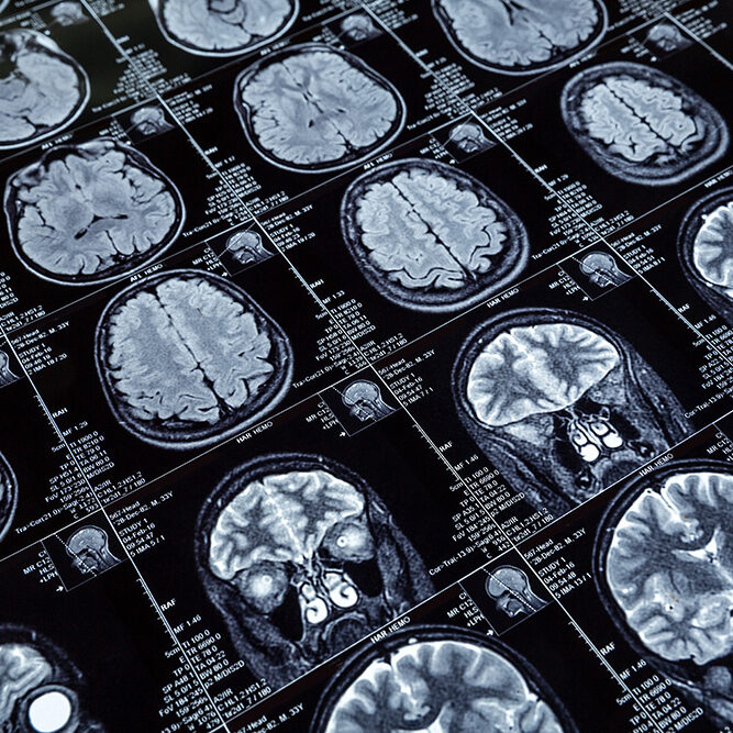 Magnetic resonance imaging (MRI) brain scans